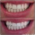 3 x 20 min tandenbleekbehandeling
