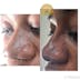 Non surgical  rhinoplasty (nose )N200,000)